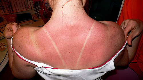 Example of a sunburn you can get from being outdoors hunting or fishing