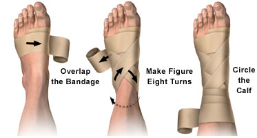 splints and braces for adventure first aid